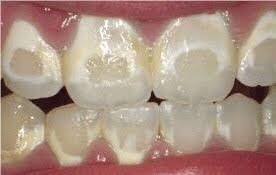 Maybe you would like to learn more about one of these? Why Is It Important To Get Rid Of Cavities Before Getting Braces Quora