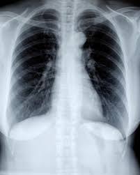 Image result for Chest XRay Interpretation