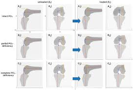 Image result for PCL Sulcus Test