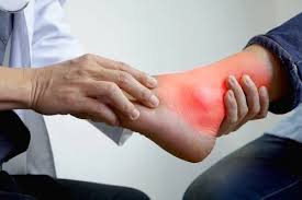 Image result for gout symptoms toe