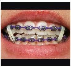 Braces Colors Ideas Power Chains Bracescolorsideaspowerchains Purple Braces Power Chain Braces Rubber Bands Braces Bands Braces Colors