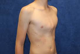 It generally presents during childhood and worsens through adolescence. Pectus Carinatum Causes Symptoms Brace Surgery Treatment