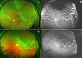 +61 8 8444 6500 auinfo@optos.com building the retina company optos.com opto map color image highlighting both the retinal tear and pvd, both in the far periphery. Evaluation Of Rhegmatogenous Retinal Detachments Using Optos Ultrawide Field Fundus Fluorescein Angiography And Comparison With Etdrs 7 Field Overlay Sciencedirect