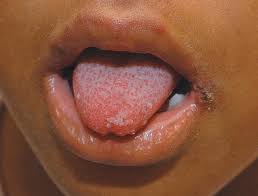 Image result for Rhus Dermatitis