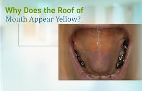 Image result for Oral thrush roof of mouth