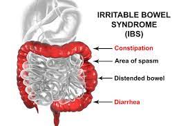 Irritable Bowel Syndrome Ibs Symptoms Treatment Parkway East Hospital