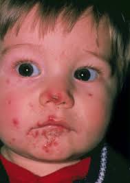 Image result for yellow scabs on the face in children