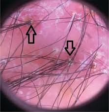 I was skeptical at first, but this is one of the only products i have found after extensive searching that specifically claims to treat white piedra. Infections Infestations And Neoplasms Of The Scalp Intechopen