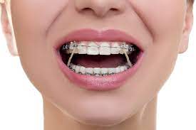How long it will take? How Orthodontic Elastic Bands Work Belmar Orthodontics