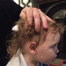 Winning The War Against Headlice Dear Mummy Blog