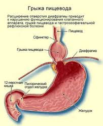 Pochemu Voznikaet Oshushenie Koma V Gorle Vozmozhnye Prichiny Chuvstva Zhzheniya I Raspiraniya Za Grudinoj Prichiny Diagnostika I Lechenie