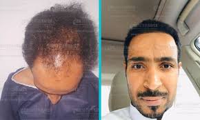قبل وبعد زراعة الشعر