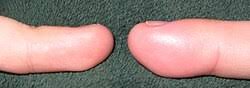 Image result for Localized Edema