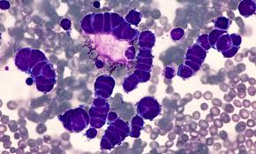 Learn about the symptoms and what to expect after diagnosis. Study Points To Treatment Approaches For Advanced Small Cell Lung Cancer