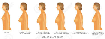 Breast Shape Chart Degrees Of Breast Ptosis Set With Woman