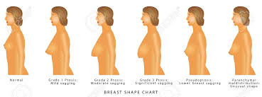 breast shape chart degrees of breast ptosis set with woman