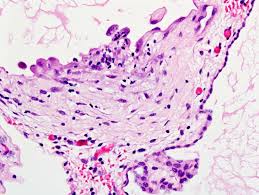 Even less common is the type of benign mesothelioma that originates in the. Case Of The Week 205