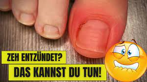 Zeh Entzundet Das Kannst Du Tun So Behandelst Du Einen Entzundeten Zeh Youtube