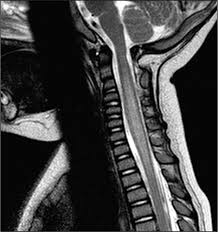 Compression of the upper spinal cord, multiple sclerosis, transverse myelitis, behçet's disease, osteogenesis imperfecta lhermitte phenomenon , also called the barber chair phenomenon , is an uncomfortable electrical sensation that runs through the back and into the limbs. Diagnosis And Treatment Of Pediatric Acute Transverse Myelitis Pediatric Annals