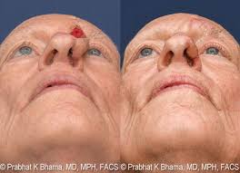 If you have a lung injury or illness, your doctor may tell you you need to have lung surgery as part of your treatment. Skin Cancer Before After Photos