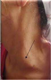 What are supraclavicular lymph nodes? Supraclavicular Lymph Node Metastases From Distant Primary Tumors Case Reports And Review Of The Literature Sciencedirect