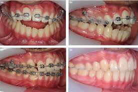 In fact, improvised treatments may even aggravate the patient's condition. Timing Orthodontic Treatment Early Or Late Fleming 2017 Australian Dental Journal Wiley Online Library