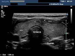 Pin On Thyroid Ultrasound