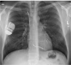 0212 986 06 50whatsapp i̇letişim: Der Implantierbare Cardioverter Defibrillator Bei Padiatrischen Patientinnen Und Jungen Erwachsenen Pdf Kostenfreier Download
