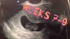 Your mucus plug debuts at the week's close, settling into the opening of your cervix. 7 9 Weeks Pregnant Spotting Youtube