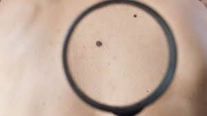 Find facts and statistics for reporting about skin cancer. What Is Melanoma Northwestern Medicine