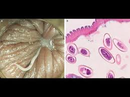 Apabila digaruk, telur akan menempel pada kuku. Enterobius Vermicularis Youtube