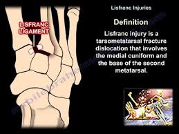 Sometimes, the injury is a simple dislocation (ligament injury), and sometimes a broken bone occurs. Lisfranc Injuries Everything You Need To Know Dr Nabil Ebraheim Youtube