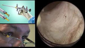 Adenomul de prostata (situat sub vezica urinara) este un obstacol in evacuarea urinii. Tratament Adenom De Prostata Chirurgie Endoscopica Dr Seyed Aghamiri Youtube