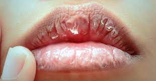 Hal ini menjadi pertanyaan, apa penyebab bibir kering dan penyebab. 11 Punca Bibir Kering Dan Menggelupas Serta Cara Mengatasi Bidadari My