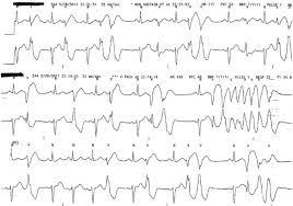 Qui a la forme d une mitre. Mitral Valve Repair Is An Effective Treatment For Ventricular Arrhythmias In Mitral Valve Prolapse Syndrome International Journal Of Cardiology