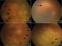 Norrie disease is an inherited eye disorder that leads to blindness in male infants at birth or soon after birth.1 features.23 norrie disease is caused by mutations in the ndp gene. Laser Photocoagulation At Birth Prevents Blindness In Norrie S Disease Diagnosed Using Amniocentesis Ophthalmology