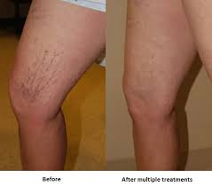 Micro Sclerotherapy My Vein Clinic My Vein Clinic