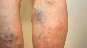 Tromboflebitis Blogs Quironsalud