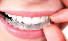 How to correct overbite without braces. How To Fix An Overbite Without Braces College Plaza Dental Associates