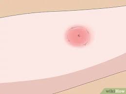 Spiders have venom which is evolved for paralyzing prey; 3 Ways To Treat Spider Bites On Kids Wikihow