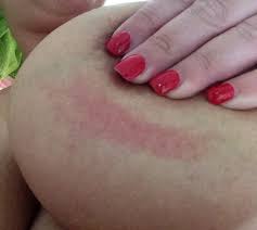 Mine had characteristics of ibc (puckering of the skin), but the onc and surgeon differed on their opinions as to whether it was or not. Breast Cancer Topic Pic Could It Be Ibc