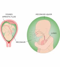 Meconium Aspiration Syndrome Mas Causes Signs Treatment