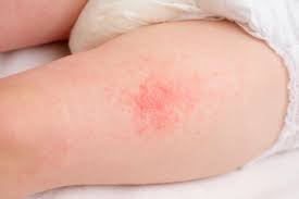 Image result for dermatitis contacta allergica