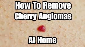 The significance of cherry angioma. Diy Removing Cherry Angiomas At Home Youtube
