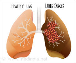 A series of mutations in the dna of the cell creates cancer. Long Term Exposure To Asbestos May Trigger Lung Cancer