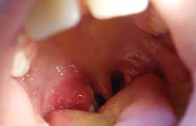 Continuum Nina Con Fiebre Y Amigdalitis Exudativa De Repeticion Sin Respuesta A Antibioticos