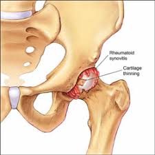 We did not find results for: Hip Arthritis Treatment India Hip Pain Relief Delhi