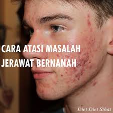Masalah Jerawat Bernanah Diet Cara Tips