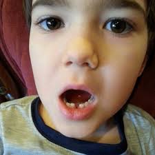 Pin On Dentalhealth