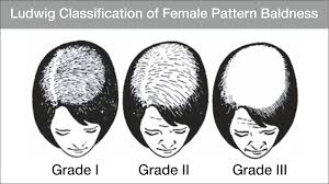 It can start any time after the onset of puberty, but women tend to first notice it around menopause, when hair. Best Female Hair Loss Clinic Female Hair Loss Natural Treatment